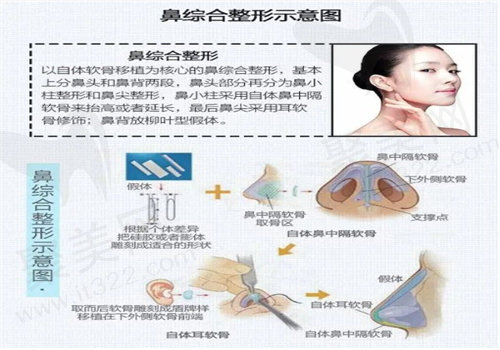 鼻综合整形示意图