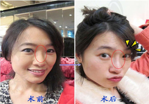 术后对比图