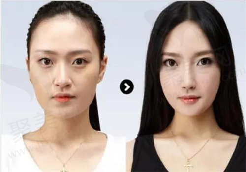 隆鼻术后图