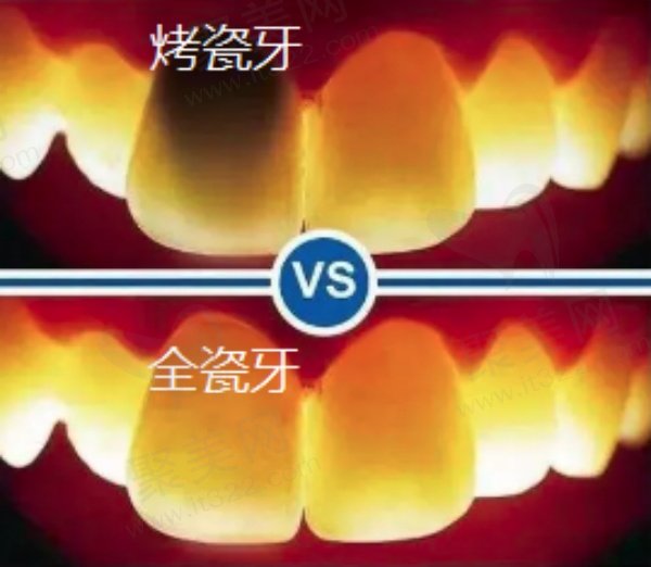 全瓷冠和烤瓷冠有什么区别