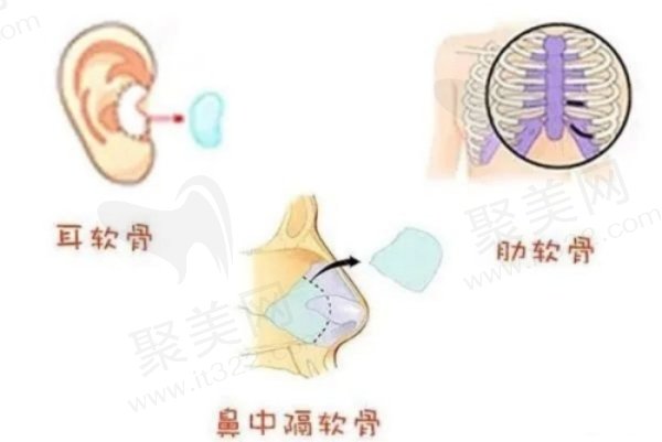异体骨能和自体骨融合吗