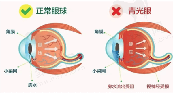 应该怎样诊断原发性慢性闭角型青光眼?