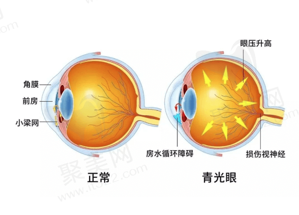 原发性慢性闭角型青光眼有什么症状