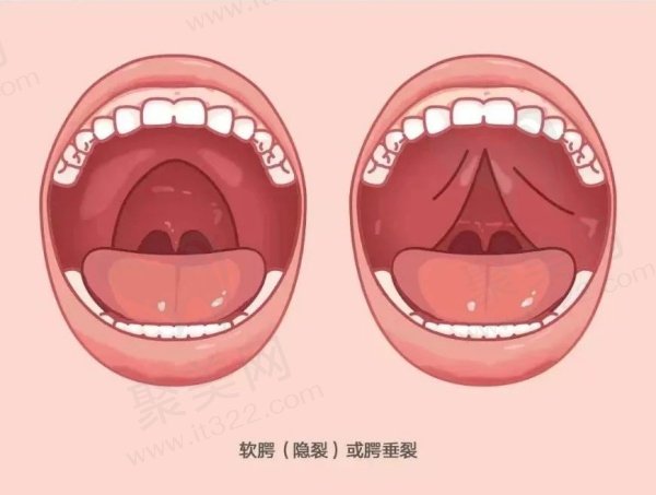 新生儿腭裂图片