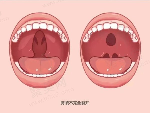 新生儿腭裂图片