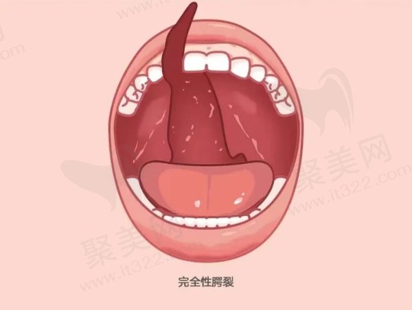 新生儿腭裂图片