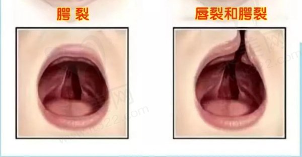 新生儿腭裂是什么原因造成的