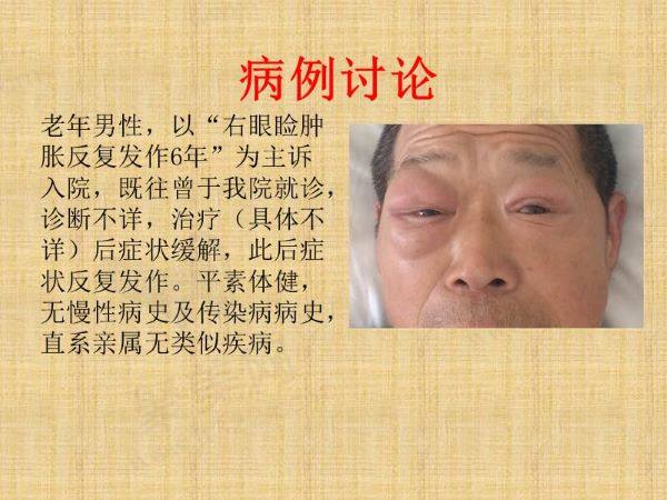 眼眶假瘤有什么症状