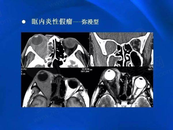 眼眶假瘤有什么症状