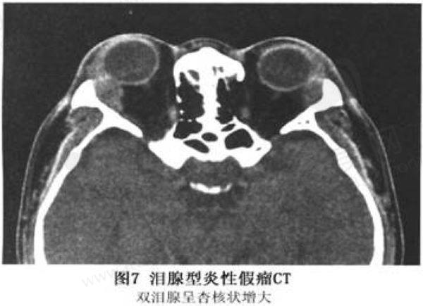 应该怎样诊断眼眶假瘤呢