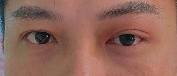 眼眶假瘤要做什么检查