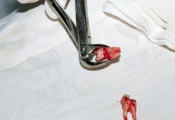 得过脑梗可以拔牙吗