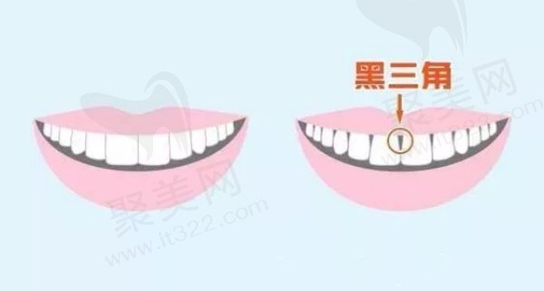 什么是黑三角