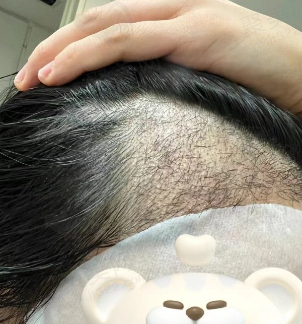 植发评价