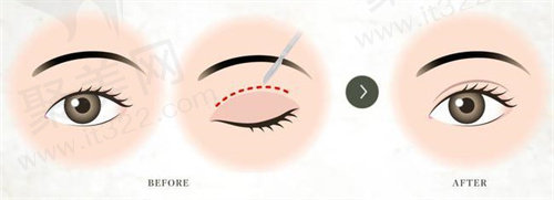 师丽丽修复双眼皮怎么样? 师丽丽修复双眼皮怎么样?