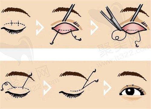 师丽丽双眼皮修复价格 师丽丽双眼皮修复价格