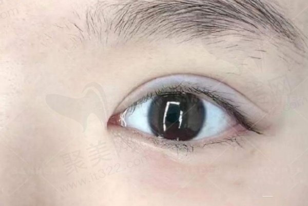 周敏茹双眼皮做的咋样