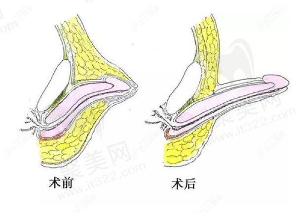玻尿酸男性增大注射要多少钱一支
