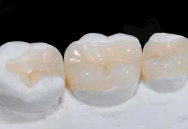 嵌体补牙