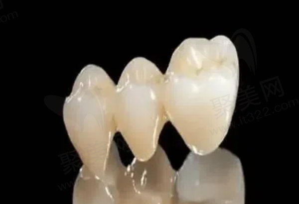 影响嵌体寿命的常见问题