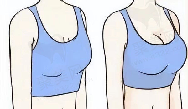 自体脂肪丰胸成效