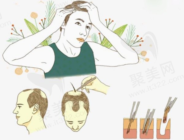 武汉碧莲盛植发