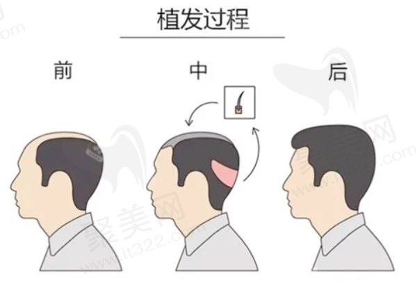 西安大麦微针植发