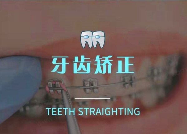 上海雅悦齿科牙齿矫正价格表