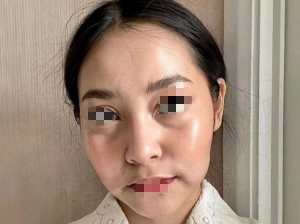 成都李建刚筋膜提升实例