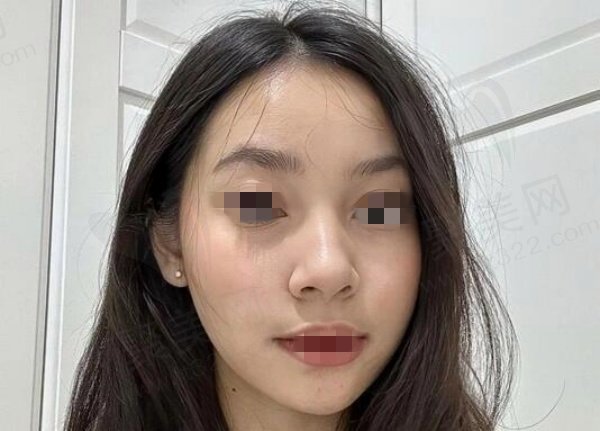 成都李建刚筋膜提升实例
