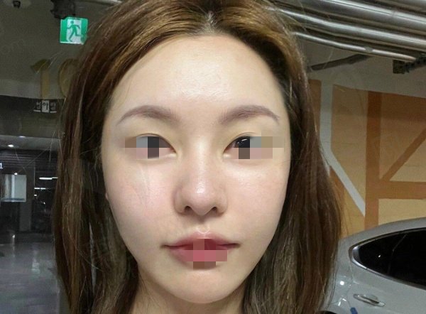 成都李建刚筋膜提升实例