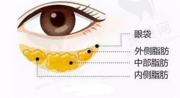老年人去眼袋用什么方法比较好