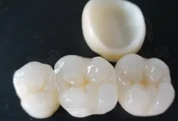 哪种金属烤瓷牙更好