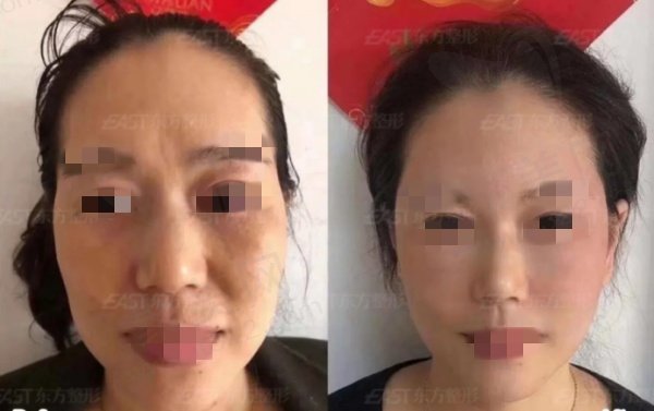 郑州贺焕焕面部拉皮提升口碑