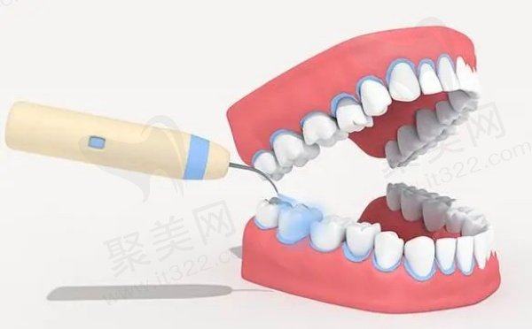 湖州金铂利口腔洗牙价格表