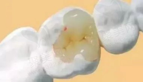 湖州金铂利口腔补牙和拔牙价格表