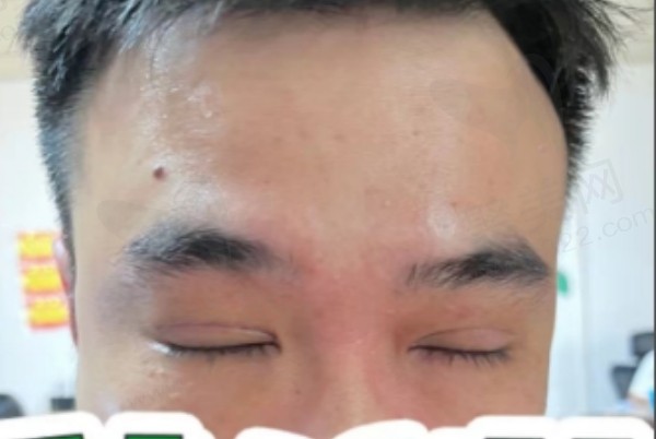 佛山曙光李淑薇医生双眼皮手术实例