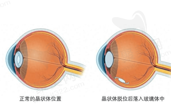 晶体脱位有什么症状？