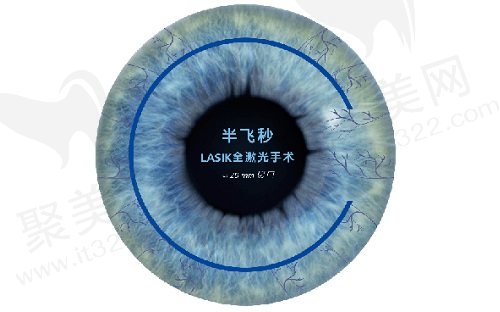 武汉爱尔眼科医院半飞秒近视手术