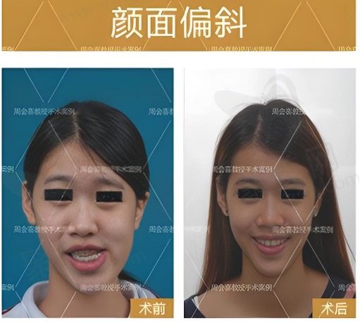 周会喜正颌手术真人实例
