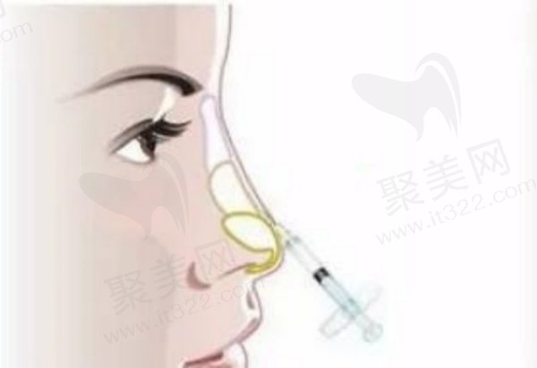 北京打玻尿酸的医生