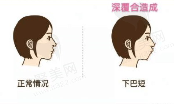 隐适美矫正深覆合大概多久？