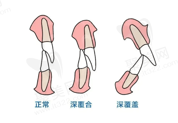 隐适美矫正深覆合大概多少钱？