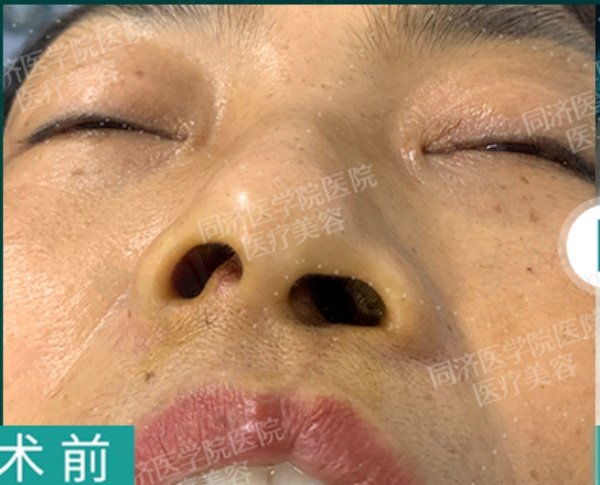 武汉叶子荣唇腭裂鼻修复实例