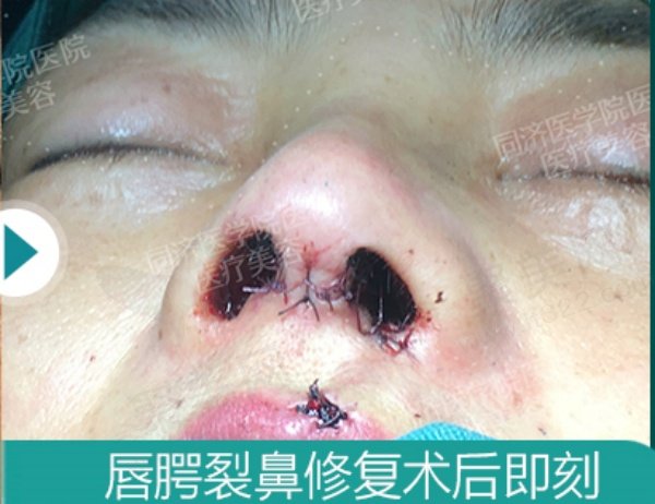 武汉叶子荣唇腭裂鼻修复实例