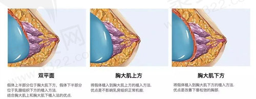南京美莱夏建军极速丰胸多久复原？