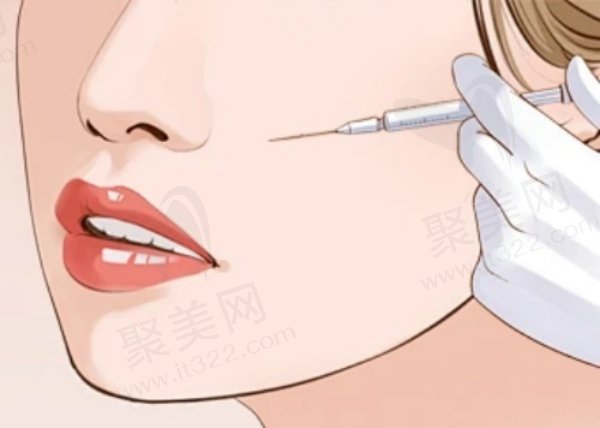 广州丽合刘中林打玻尿酸怎么样 广州丽合刘中林打玻尿酸怎么样