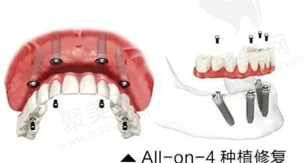 郑州中诺口腔做半口种植牙怎么样