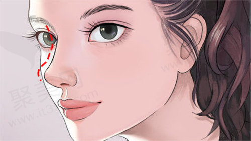 南京美莱郭心怡医生双拱蝶状仿生鼻综合价格