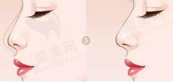 宁波付巨峰做鼻子内隐蔽缝合技术